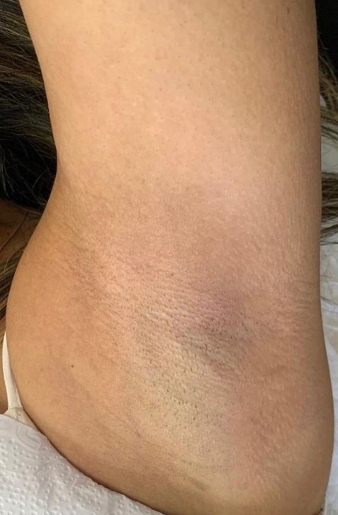 Foto de resultado após a rotina — caso 2