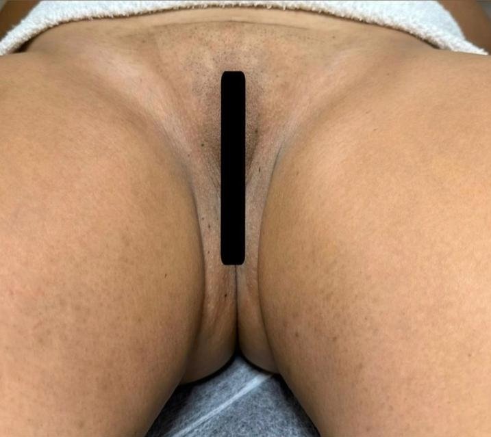 Foto de resultado após a rotina — caso 4